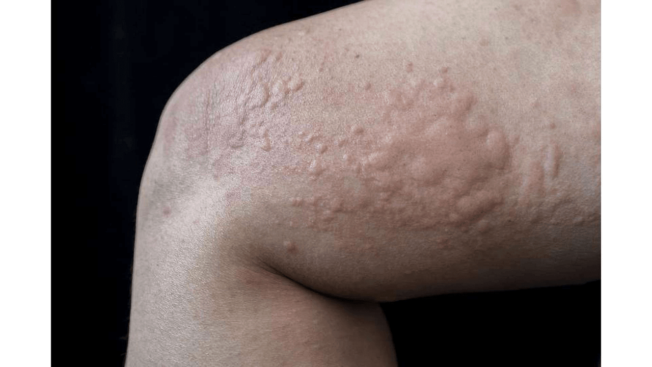 Hives Warning Signs What to Look Out For