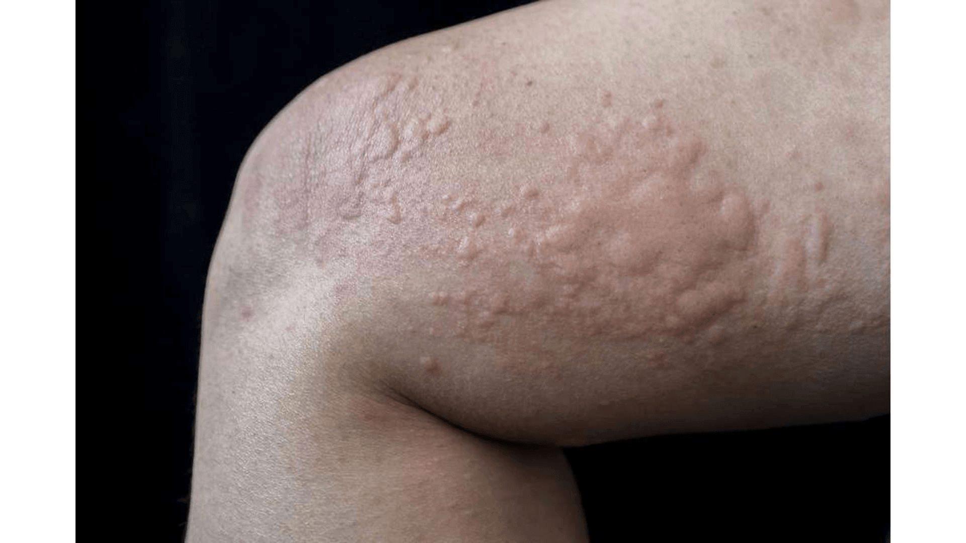 Hives Warning Signs What to Look Out For